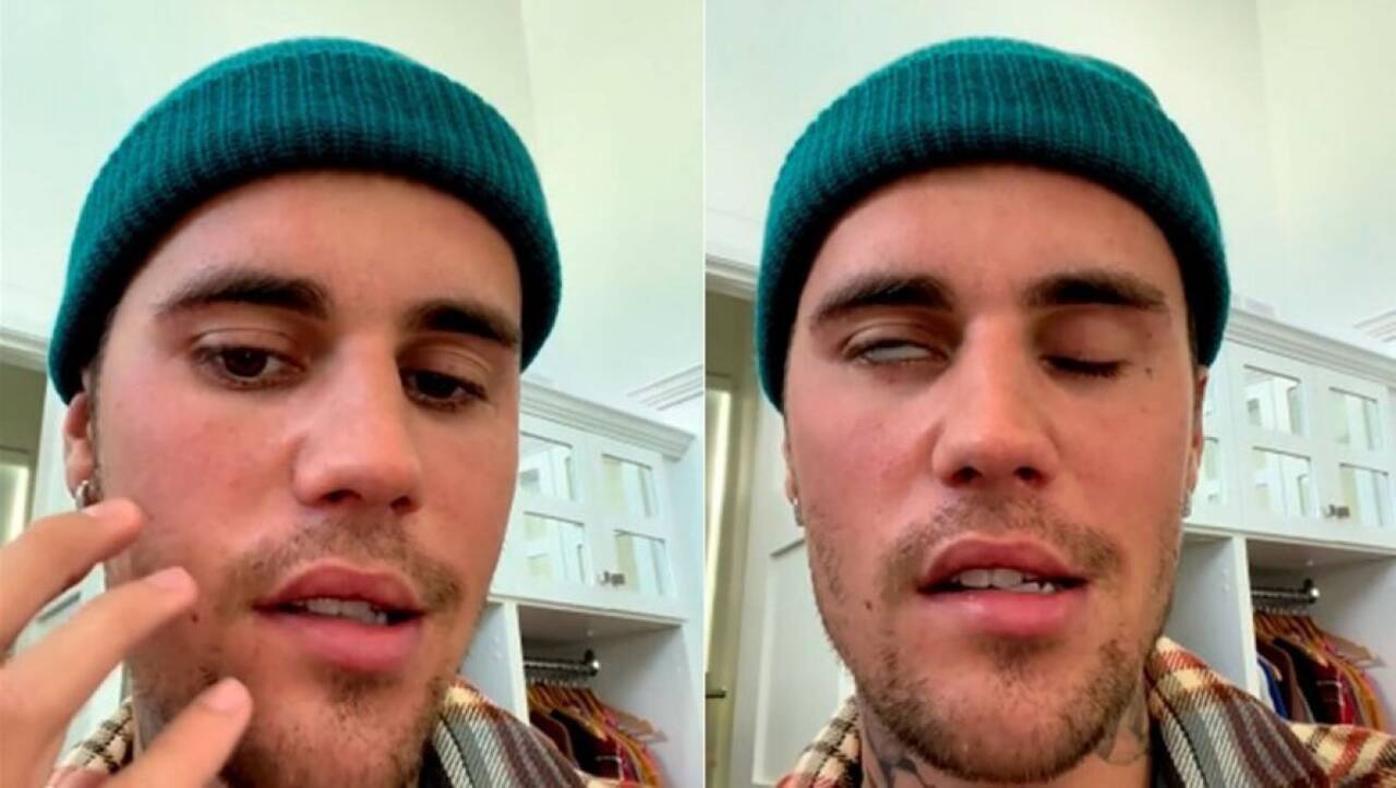 Kanadalı Şarkıcı Justin Bieber'da yüz felcine neden olan Ramsay Hunt Sendromu nedir?