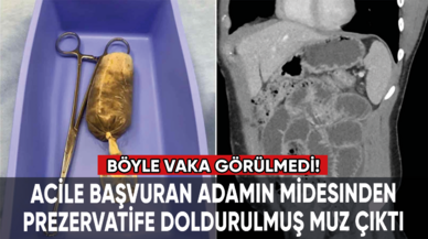 Böyle vaka görülmedi: Adamın midesinden prezervatife doldurulmuş muz çıktı!