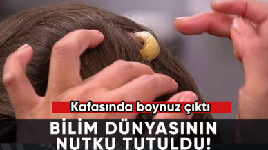 Bilim dünyasının nutku tutuldu! Kafasında boynuz çıktı