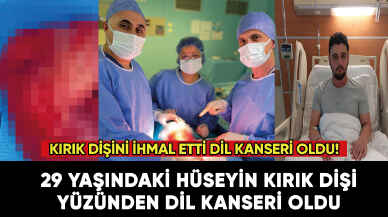 Kırık dişi yüzünden dil kanseri oldu! Dilinin yüzde 80’i alındı