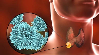 Tiroid kanseri nedir? Tedavi yöntemleri nelerdir? Uzman doktor anlattı