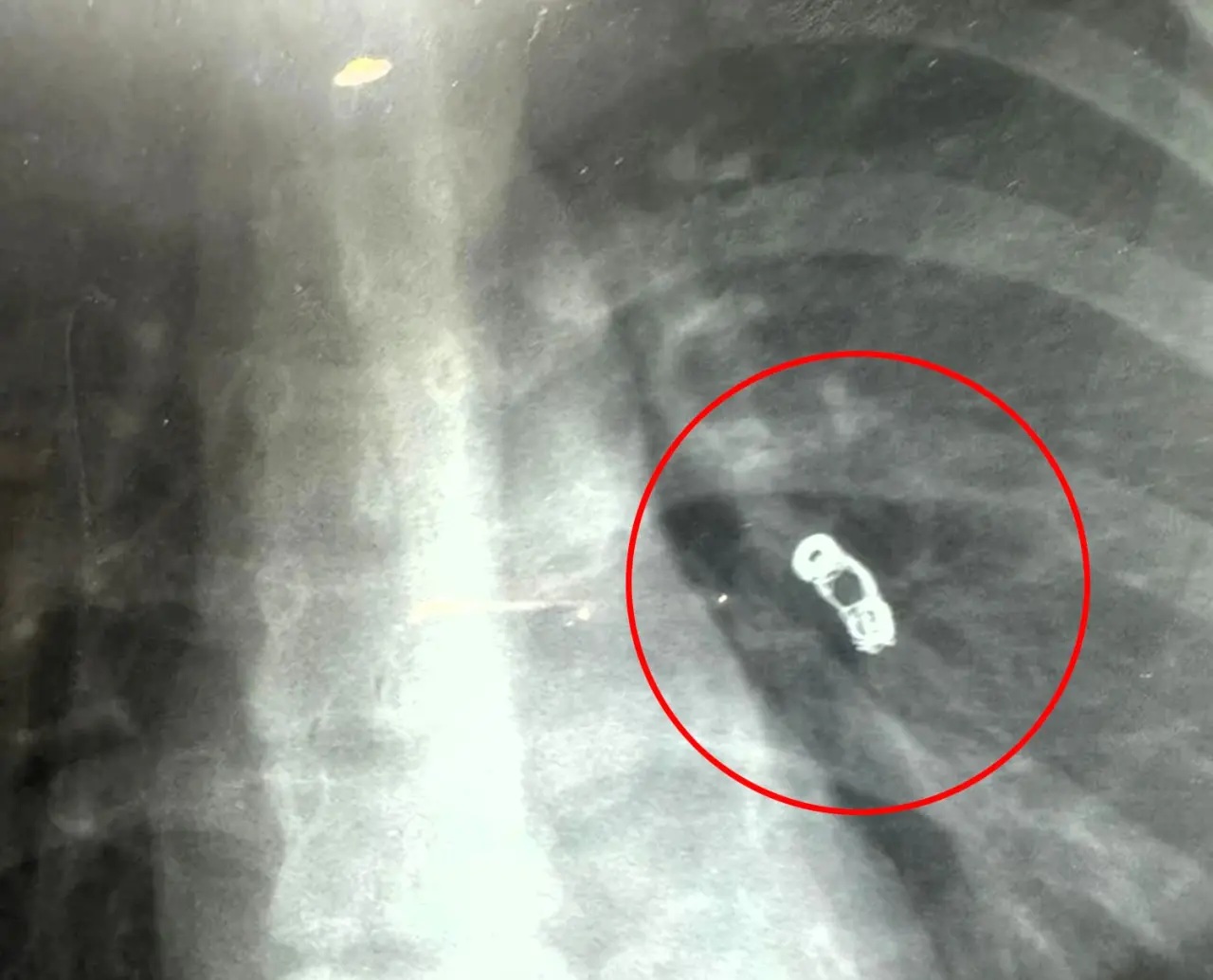 Influencer suffering cold symptoms shocked as doctors find metal COIL in  her lungs 'left over from previous surgery' | Need To Know